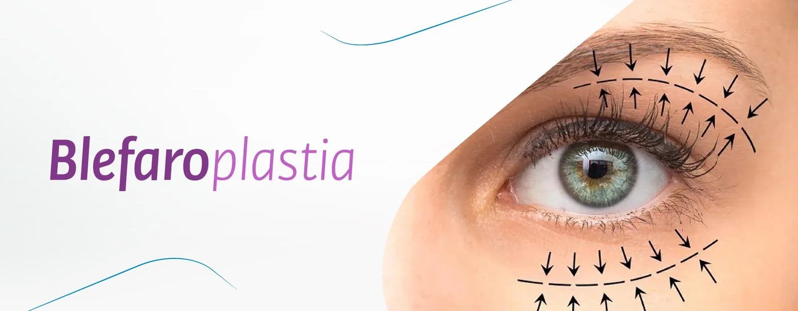 Blefaroplastia