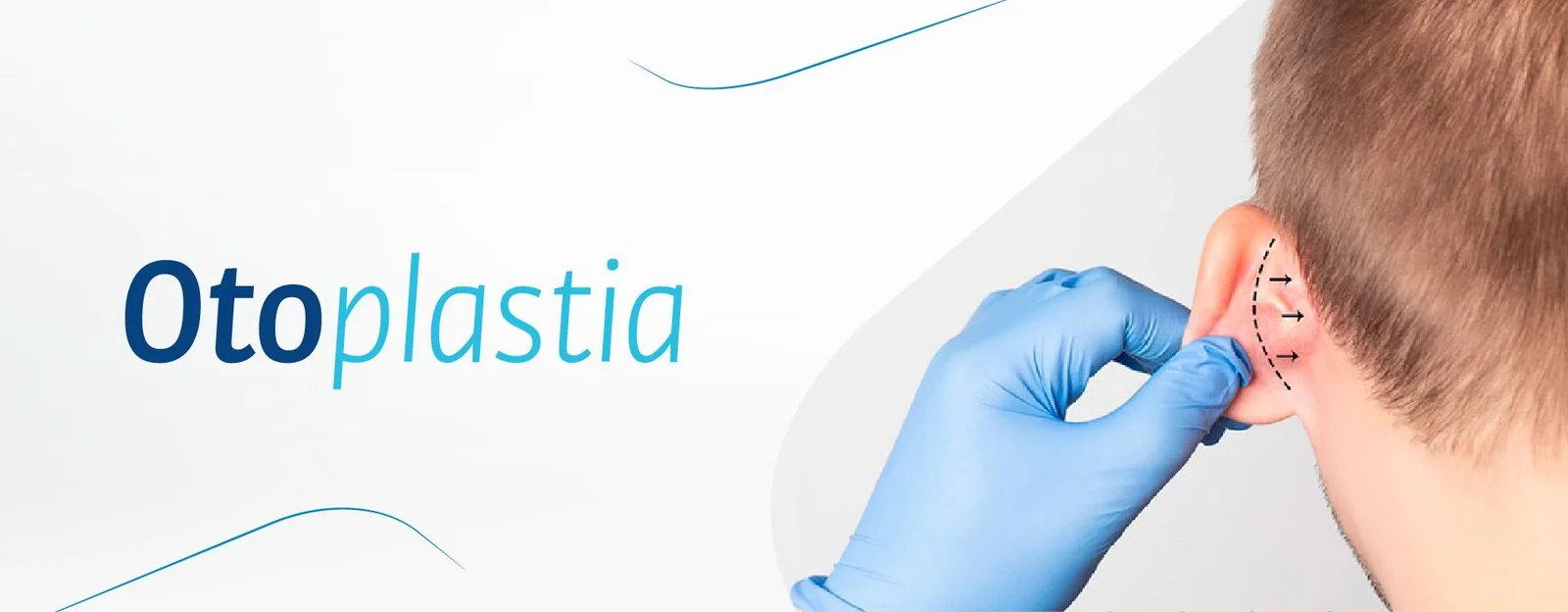 Otoplastia